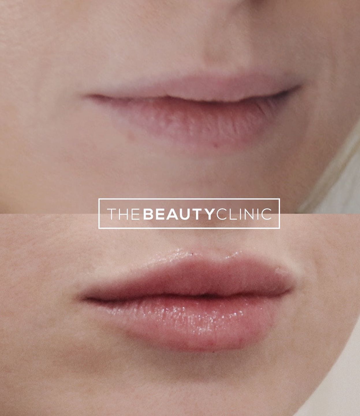 The Beauty Clinic We used Restylane Kysse to gently add volume and define the shape of these pretty lips