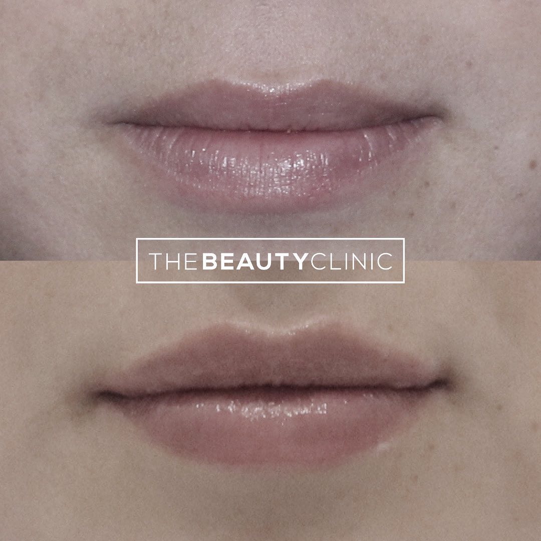 The Beauty Clinic 𝙁𝙞𝙡𝙡𝙚𝙧 𝙐𝙨𝙚𝙙: Hyaluronic acid filler (we only use FDA approved Restylane and Juvederm brands)