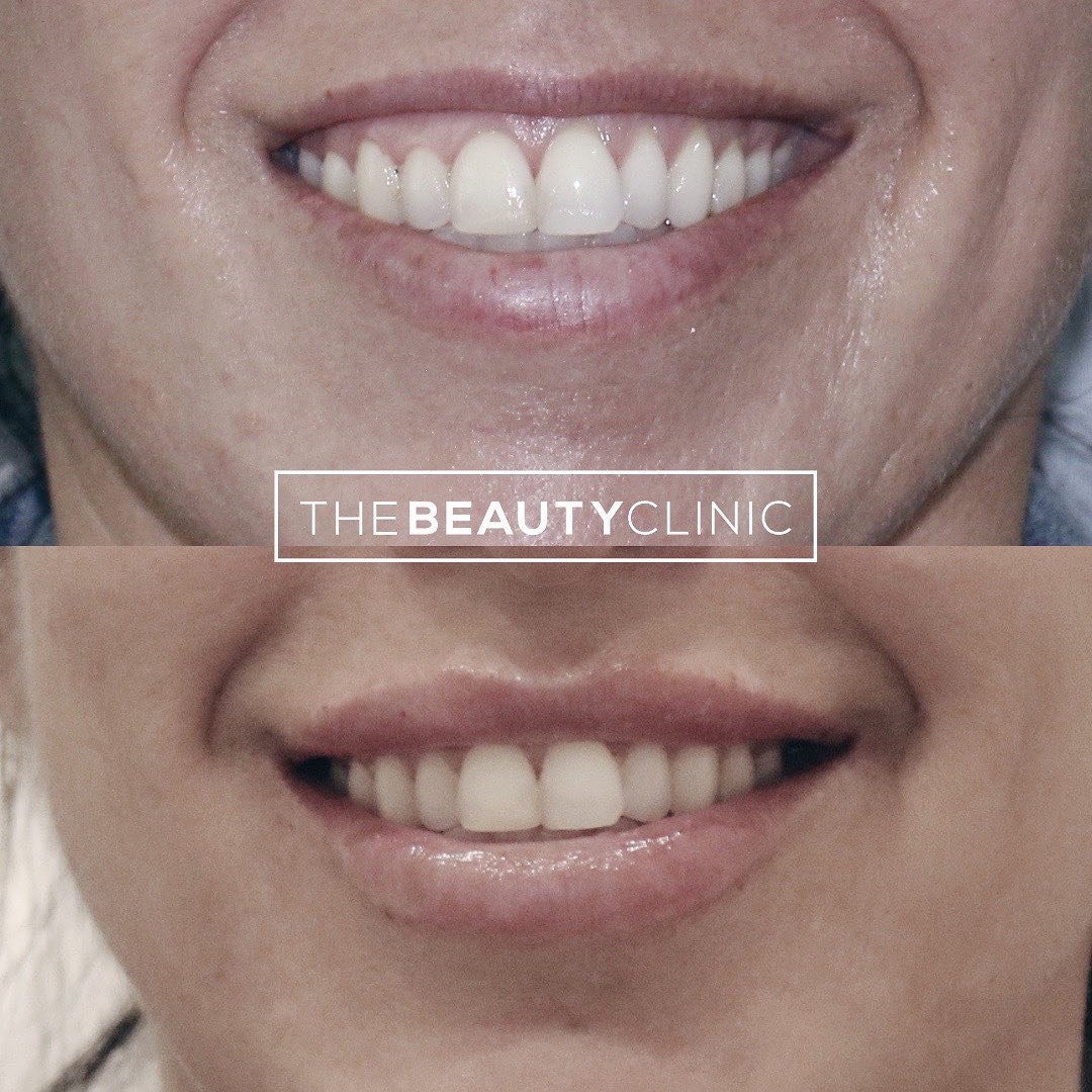 The Beauty Clinic Smile Enhancement