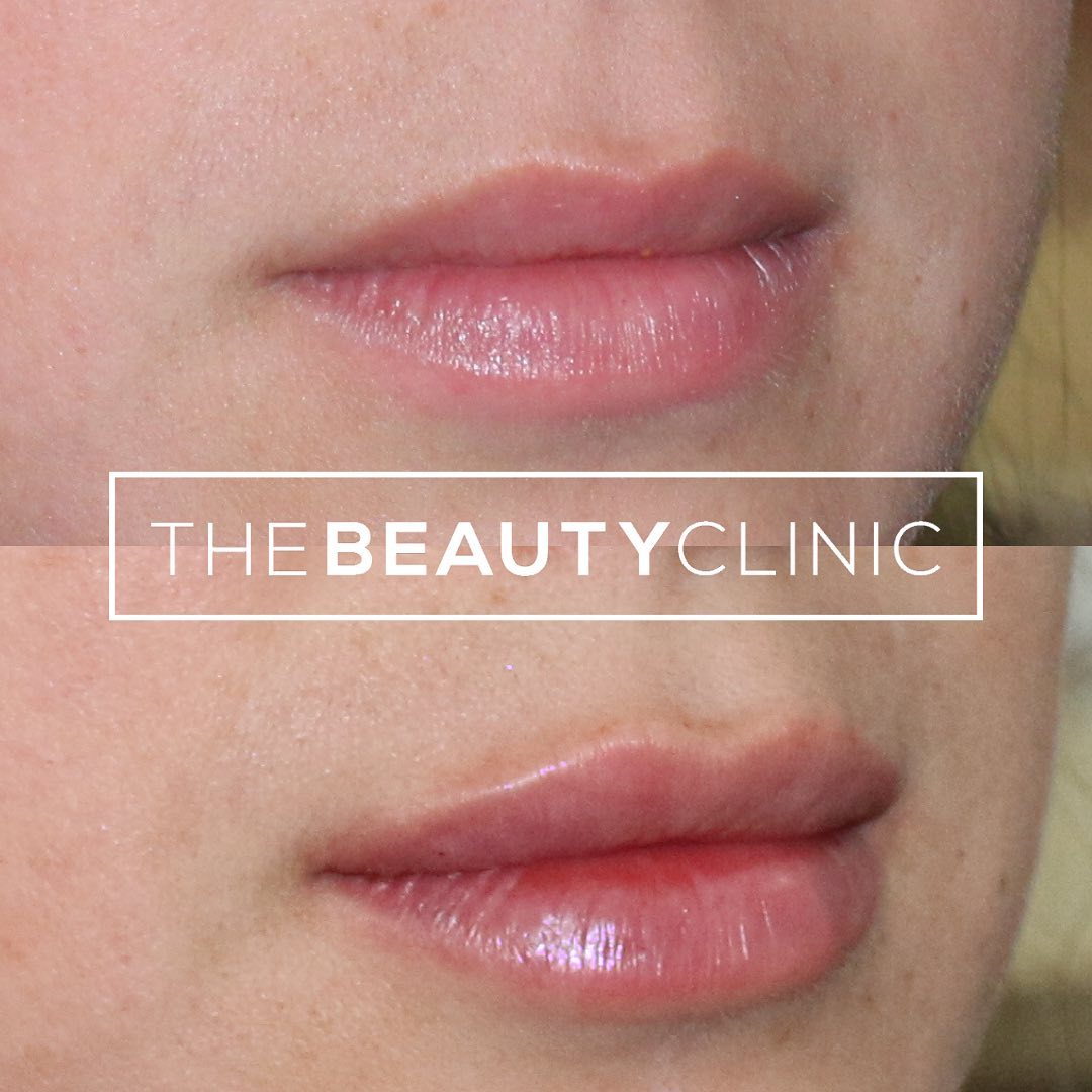The Beauty Clinic Beautifully enhanced lips