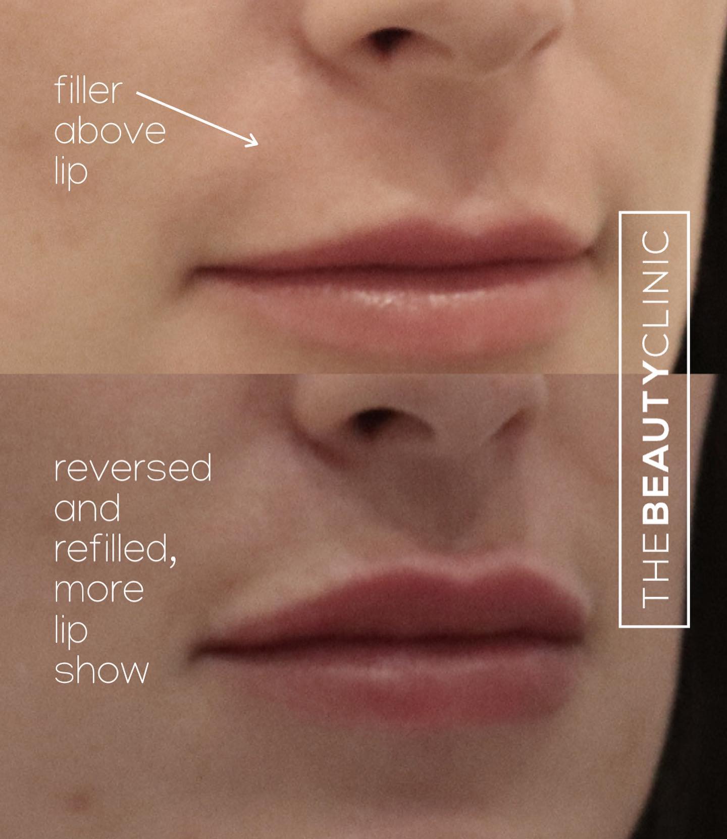 The Beauty Clinic Lip Filler