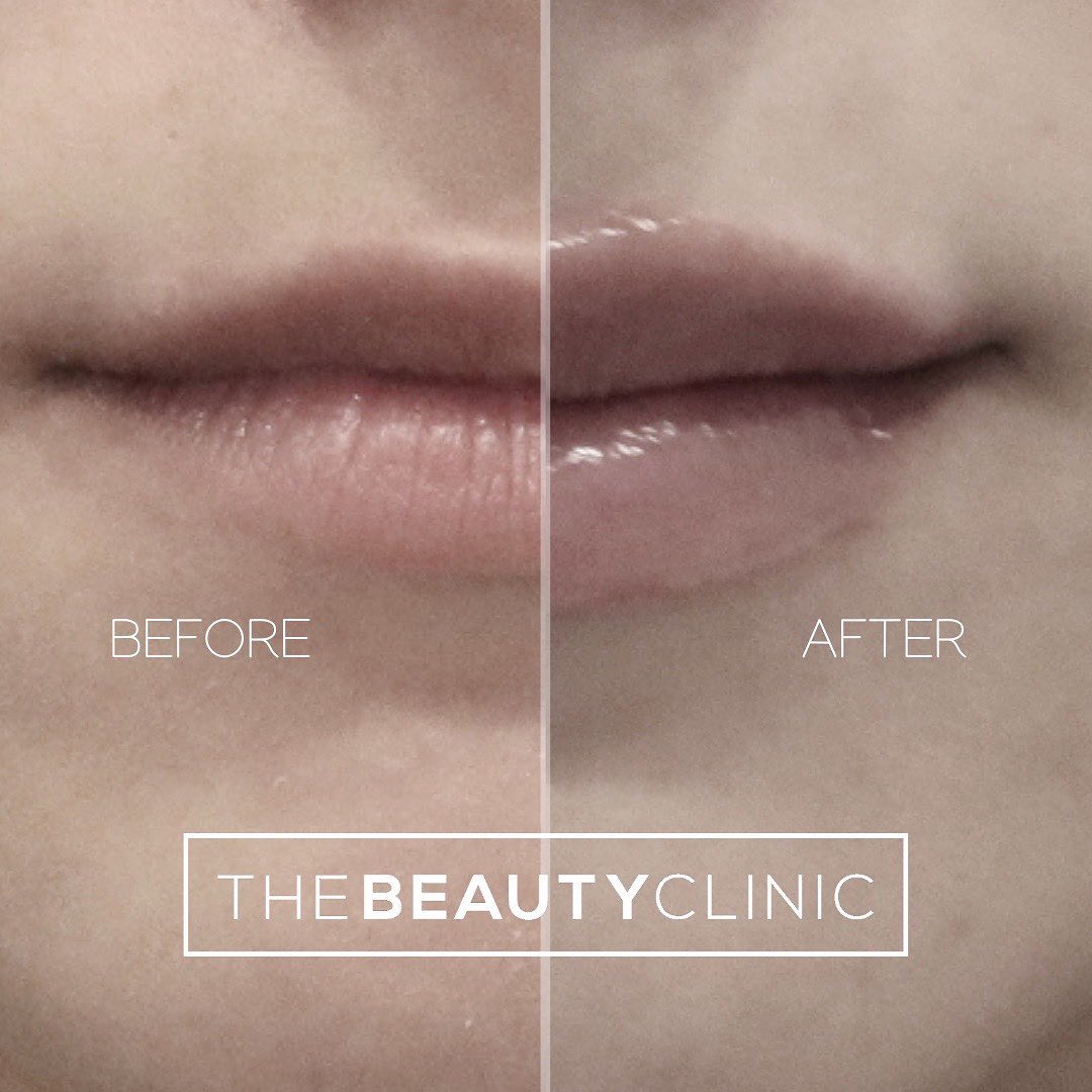The Beauty Clinic Getting lip filler doesn’t mean that you have to end up with big, dramatic lips.