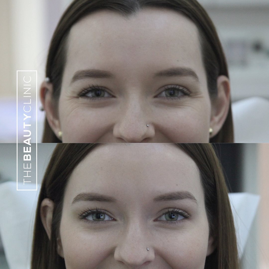 The Beauty Clinic Botox for Eyes