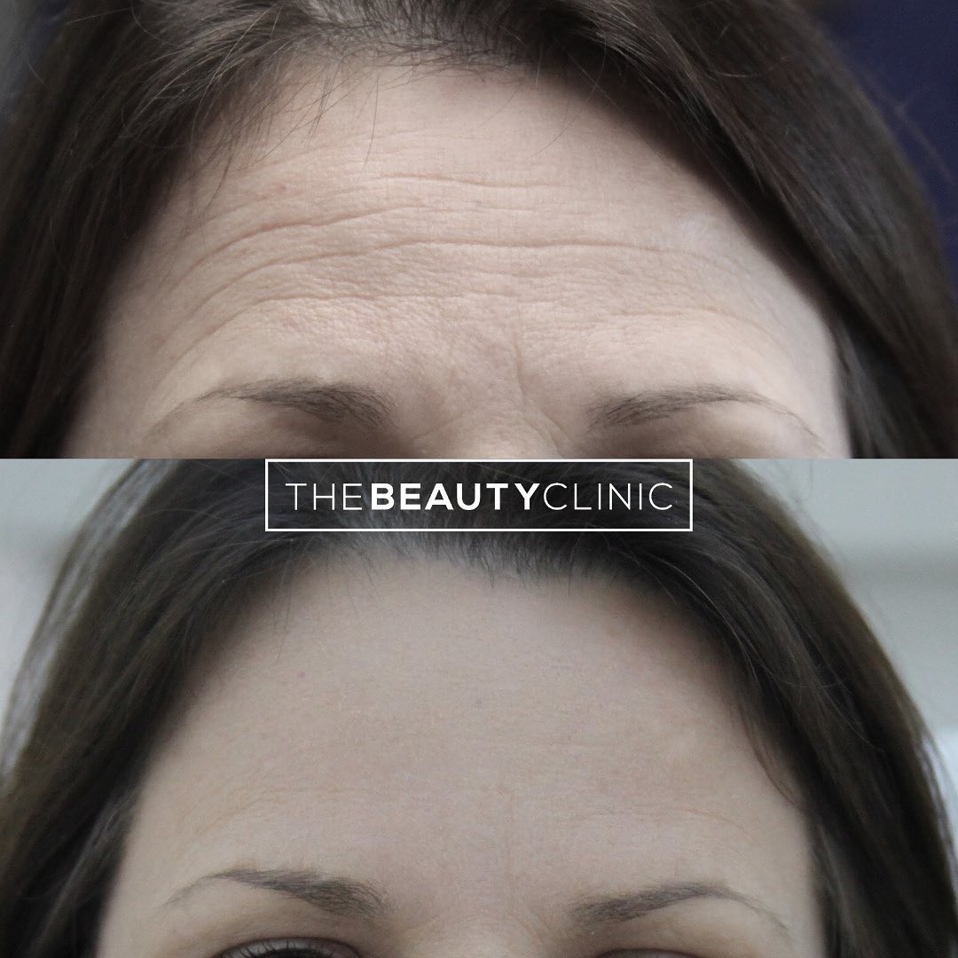 The Beauty Clinic Botox is the most common treatment we perform.