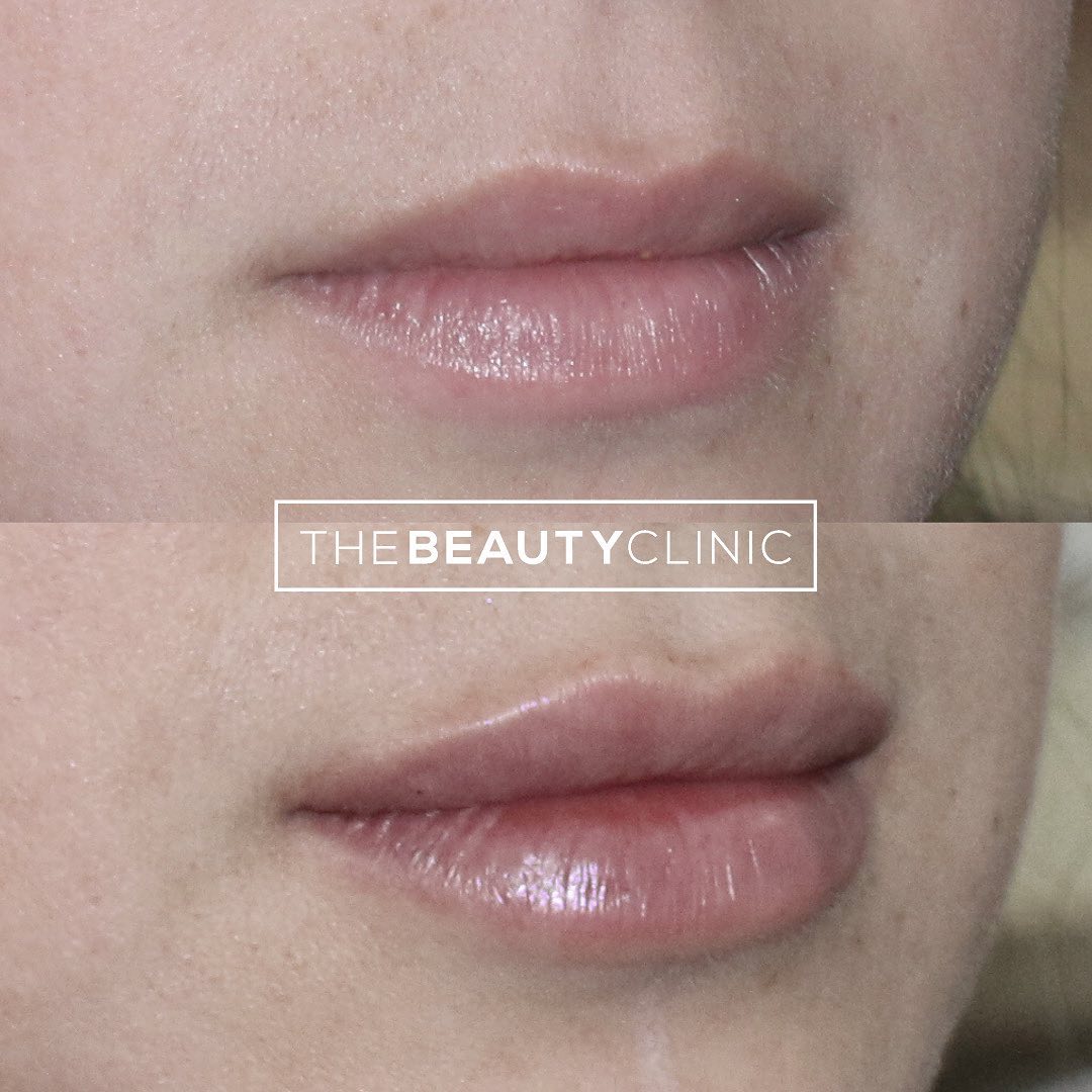 The Beauty Clinic 𝙁𝙞𝙡𝙡𝙚𝙧 𝙐𝙨𝙚𝙙: Hyaluronic acid filler (we only use FDA approved Restylane and Juvederm brands)