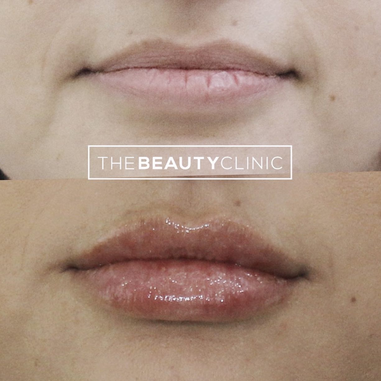 The Beauty Clinic We used 1 syringe of Restylane filler spread over two sessions to give her gradual, yet beautiful definition.