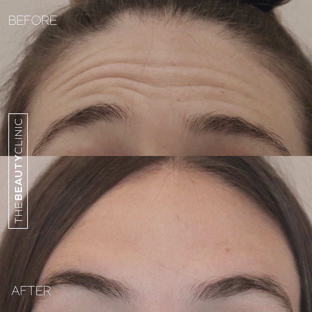 Forehead wrinkles? We made them disappear in less than 5 minutes with Botox.