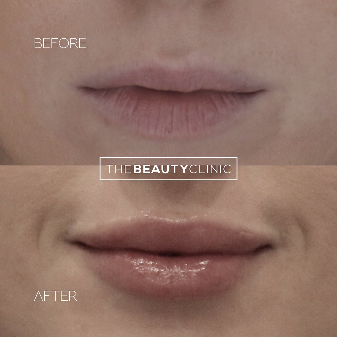 With a delicate touch and the right filler, you can have natural-looking, luscious lips 👄 We offer complimentary consultations, in which we are happy to discuss your goals and offer our specific recommendations.