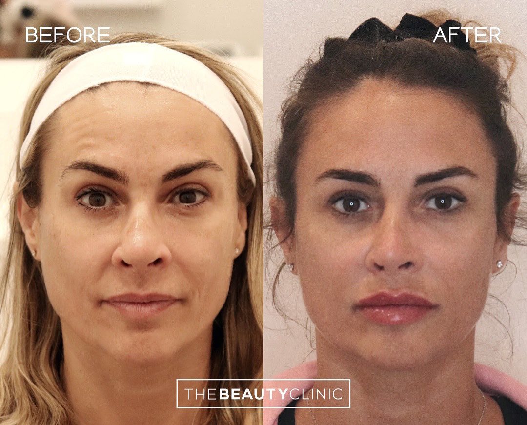 The goal is to make you look more refreshed and balanced, all while keeping you looking natural.