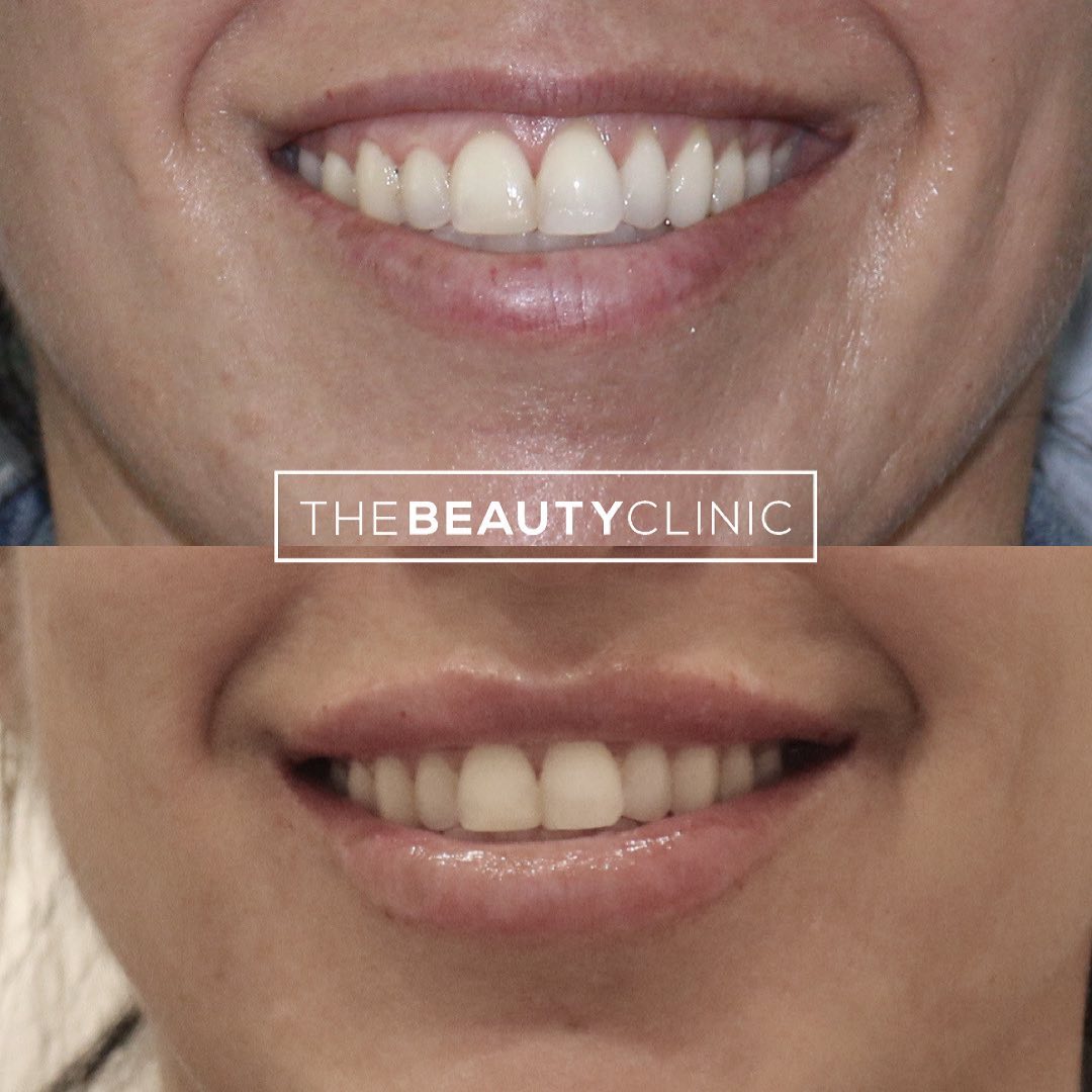 A wonderful benefit to lip filler is that it helps the upper lip “show” more when you smile (and covers more of the gums if you have a gummy smile).