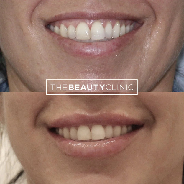 Lip Fillers