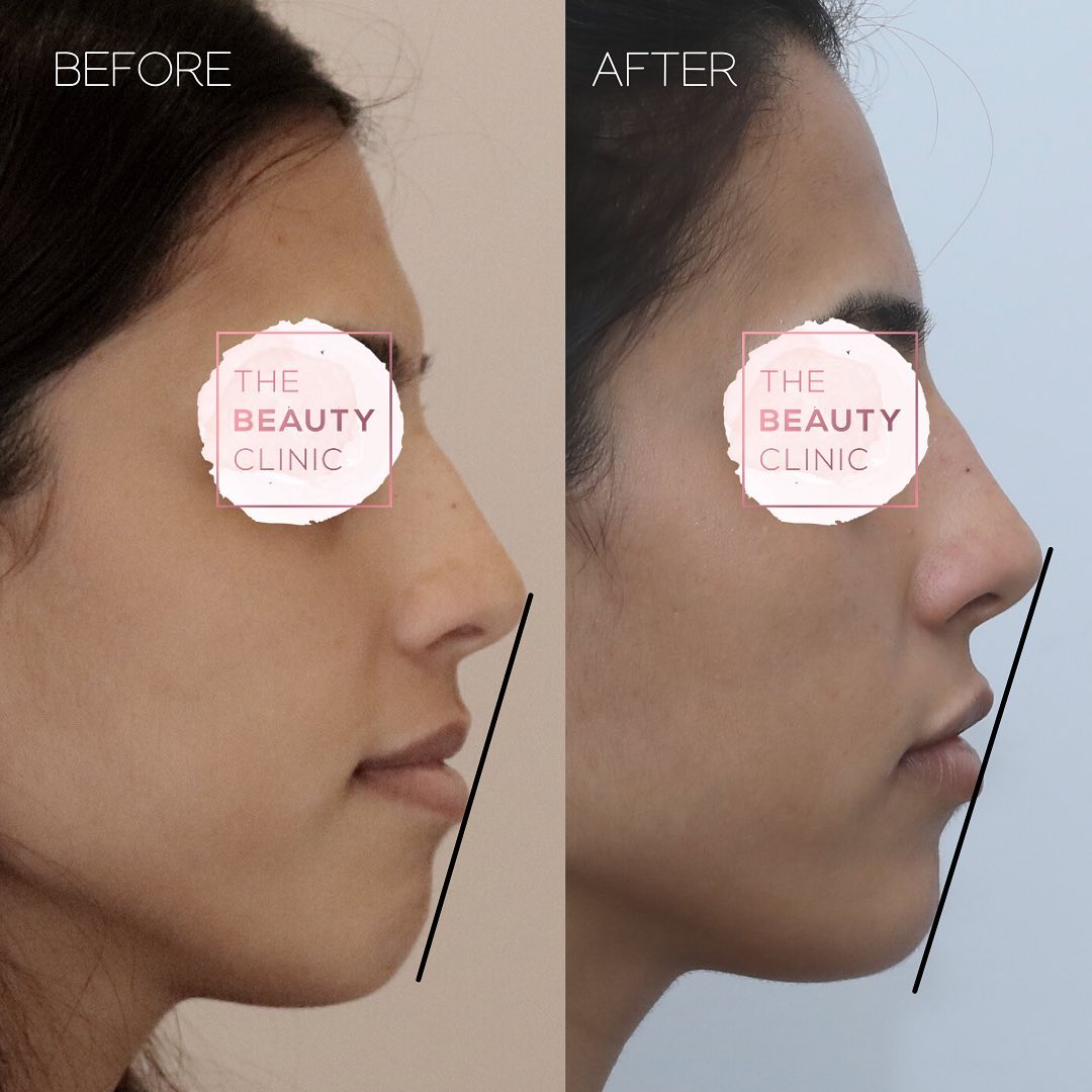 The Beauty Clinic Nose Enhancement