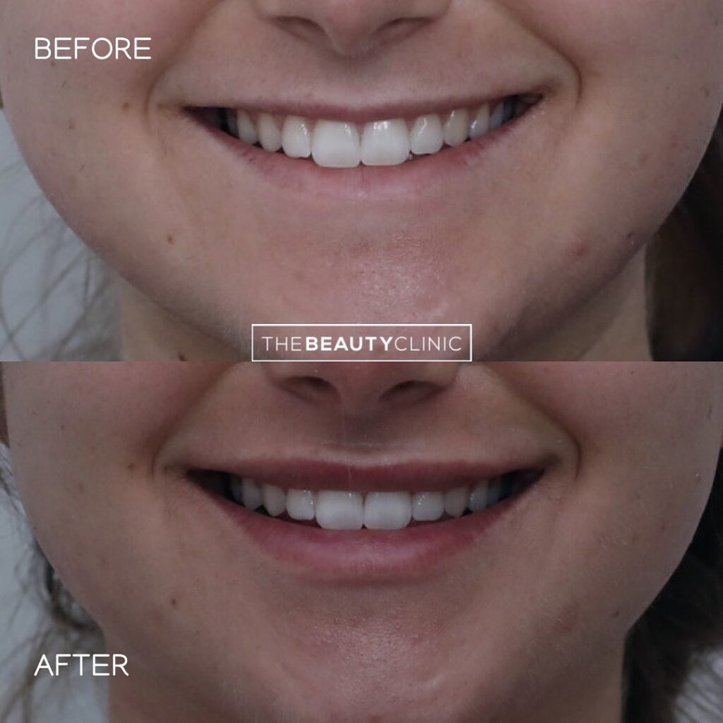 Lip filler CAN look natural. – The Beauty Clinic