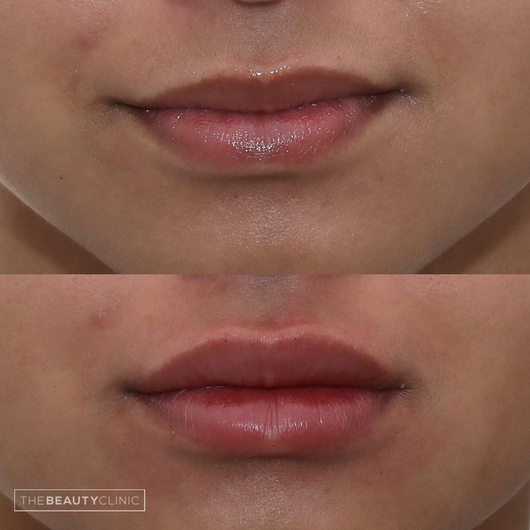 Lip filler can: Help with symmetry Help with balance Look TOTALLY natural Enhance your femininity