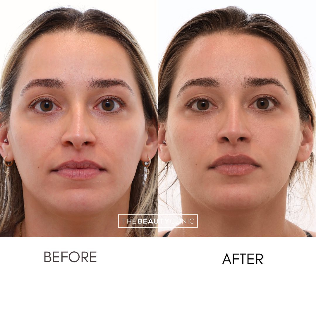 Want to look refreshed and rejuvenated - but do it 100% naturally? With PRF Biofiller now you can! Treatments done on this beauty: 👄 Totally natural lip filler (no duck lips here!) 🩸 PRF Biofiller in her smile lines (nasolabial lines), chin shadows and undereyes 💉 Botox in forehead and lower face for wrinkle prevention Notice her new glow - PRF makes you look so refreshed! 👌 PRF is a second generation PRP treatment. It’s 100% natural, regenerative and volumizing filler that contains both serum albumin and growth factors obtained through your own blood! PRF can promote collagen production and improve skin elasticity and texture. We LOVE using it undereyes, nasolabial lines, chin shadows, and more! And the best part- we inject some into your scalp to promote hair growth and prevent hair loss at no extra charge! Available at both Aventura and Fort Lauderdale. Book your treatment now: 305-882-9439
