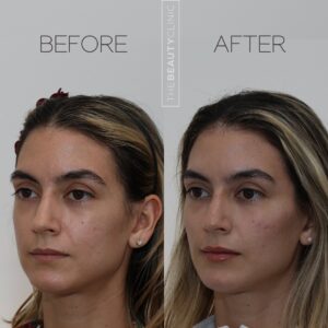 The Beauty Clinic Miami MedSpa Before and After