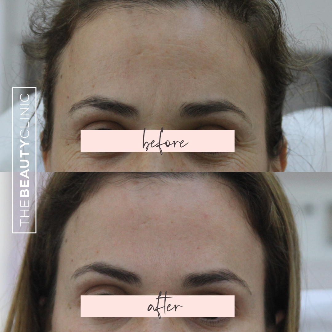 The Beauty Clinic - Toxins - Before and After