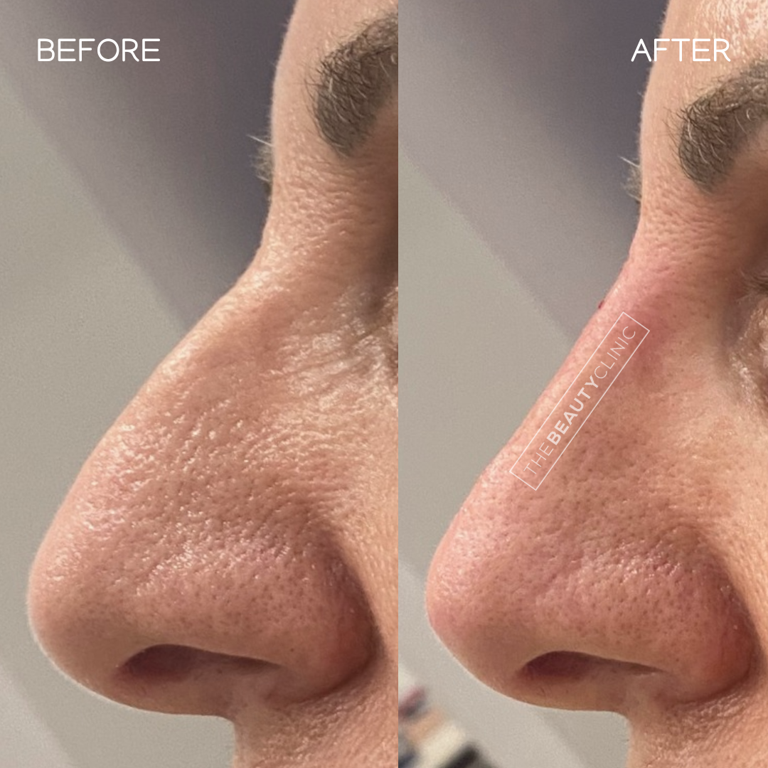 Nose Filler - Before and After - The Beauty Clinic