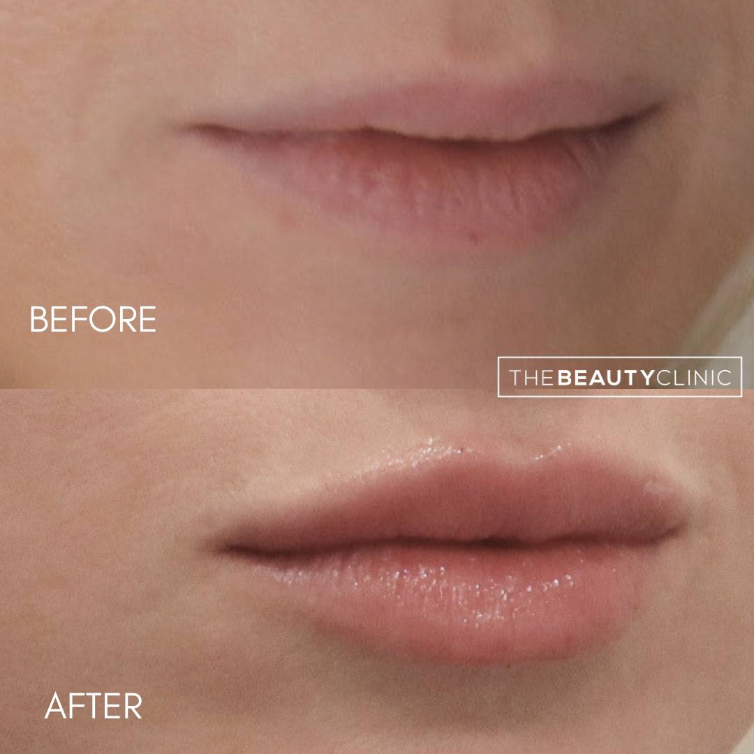 Lip Filler - Before and After - The Beauty Clinic