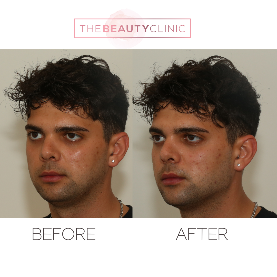 Jawline filler - Before and after - The Beauty Clinic