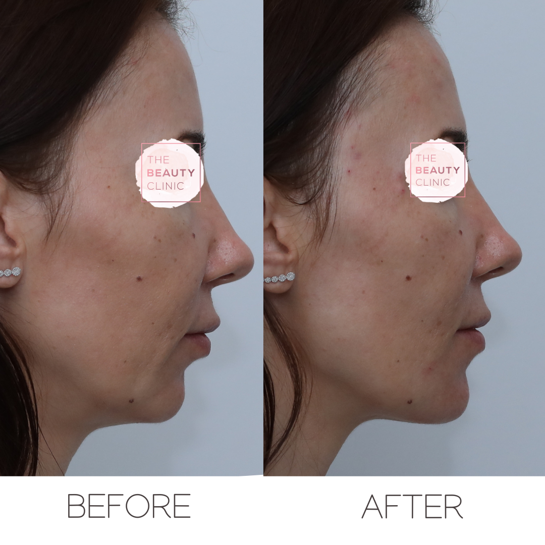 Chin filler - Before and after - The Beauty Clinic