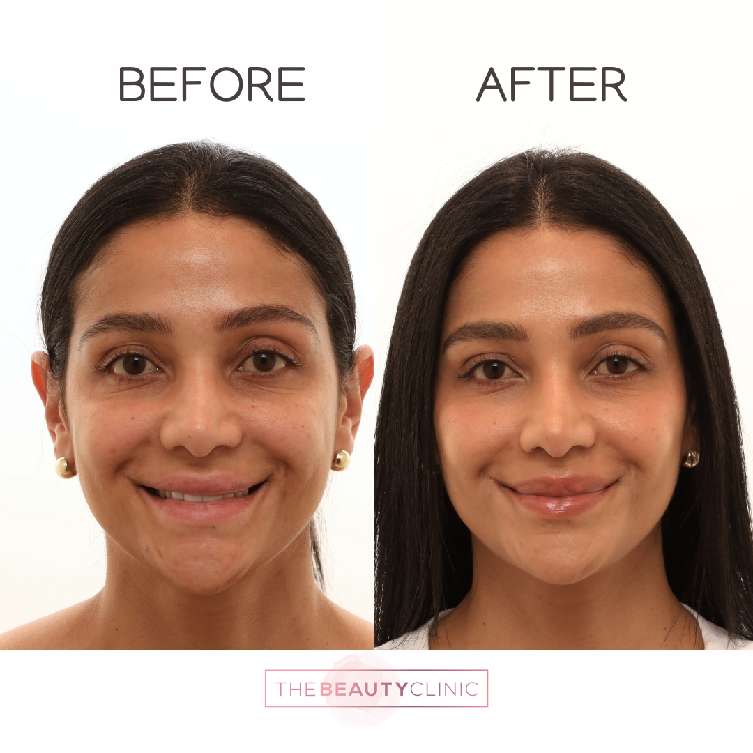 The beauty clinic - Facial Balancing with Filler - Before and after - filler