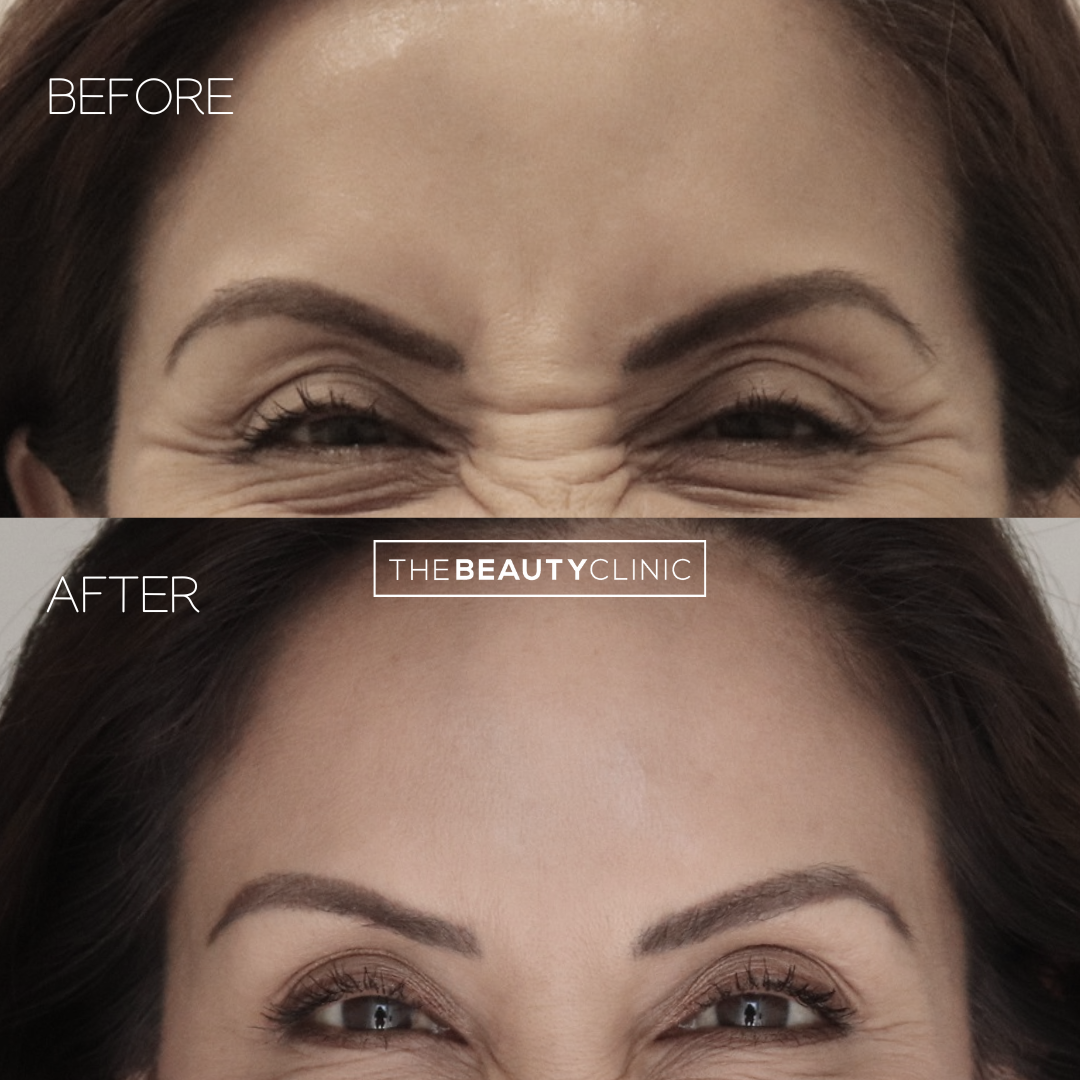 The Beauty Clinic - Toxins - Before and After