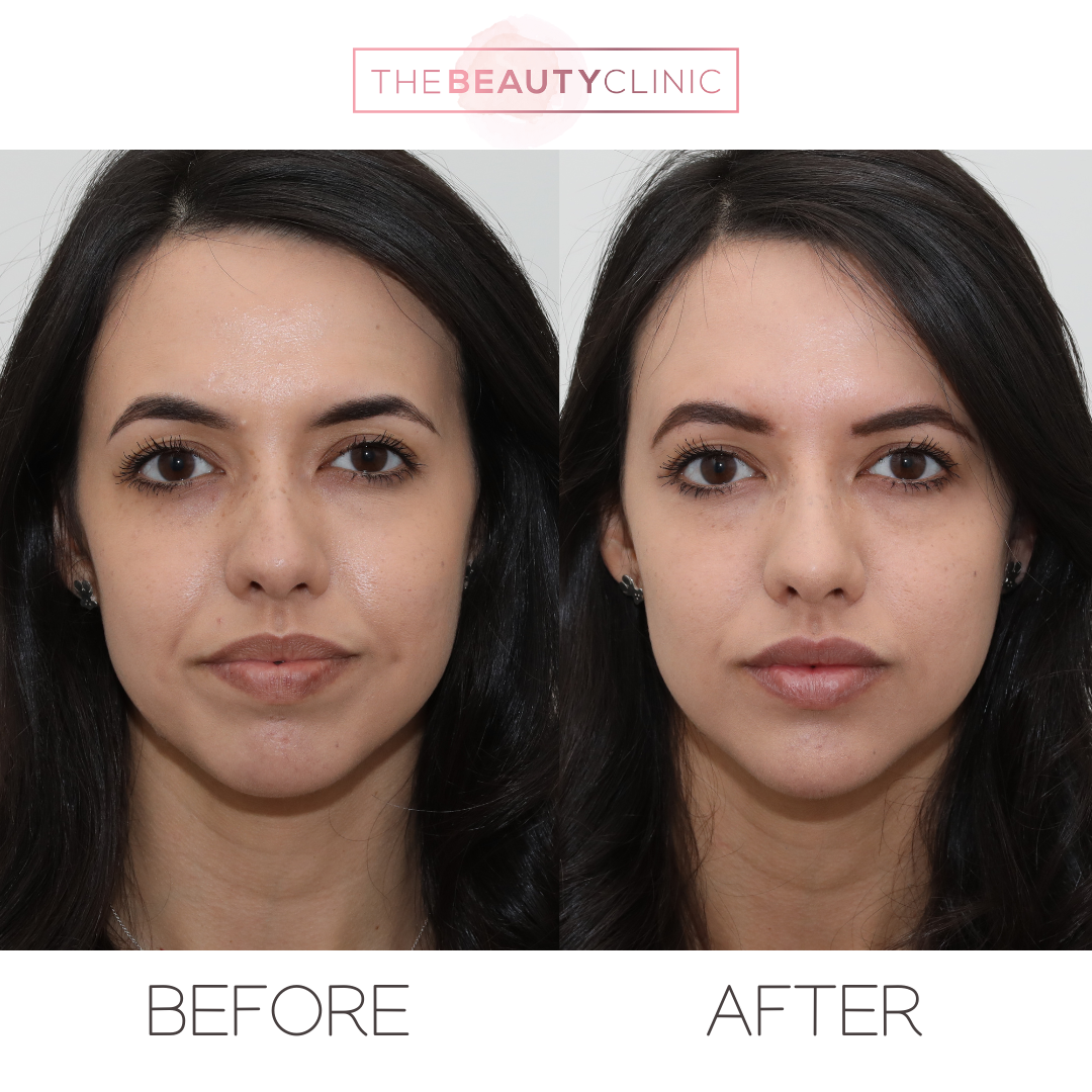 The beauty clinic - Facial Balancing with Filler - Before and after - filler