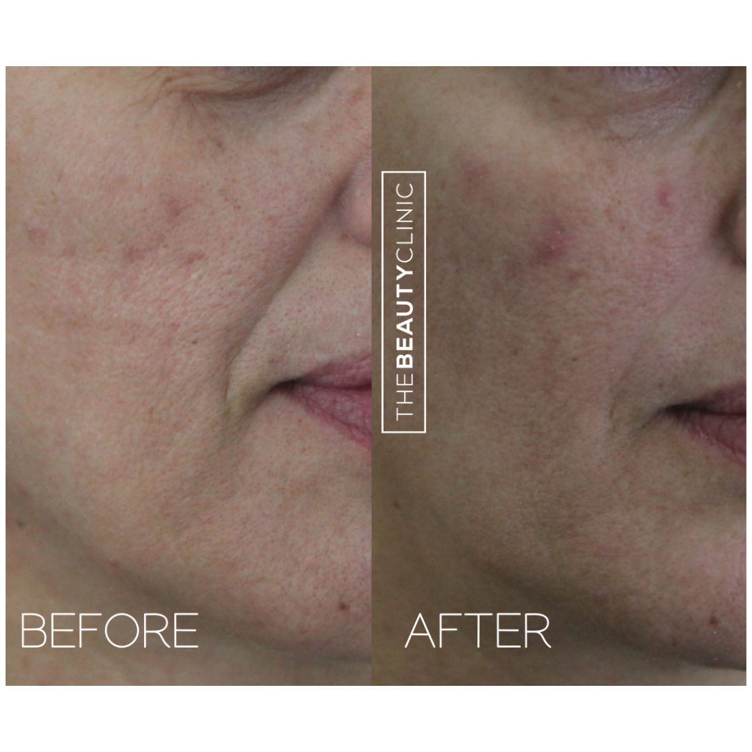 The beauty clinic - Facial Balancing with Filler - Before and after - filler