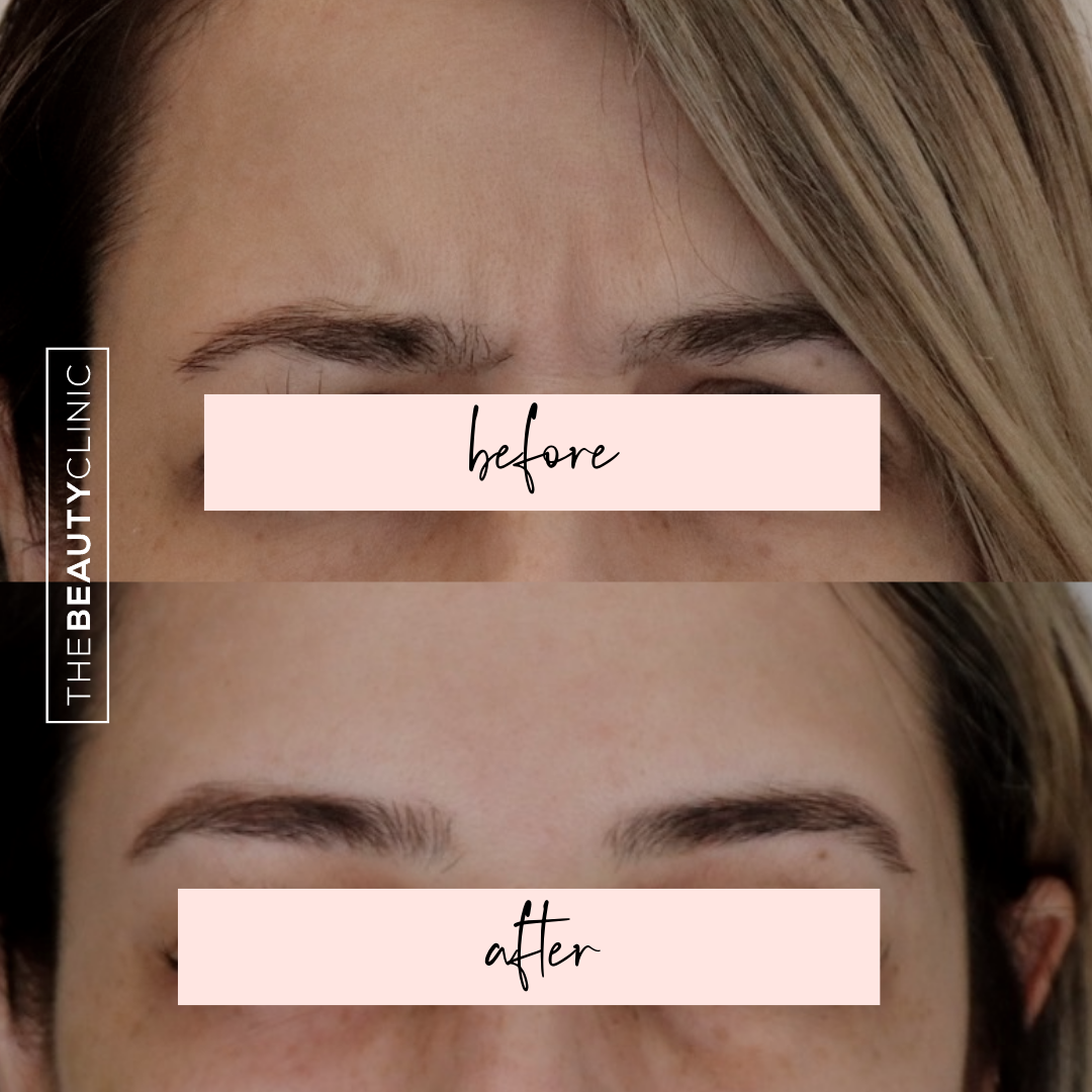 The Beauty Clinic - Toxins - Before and After