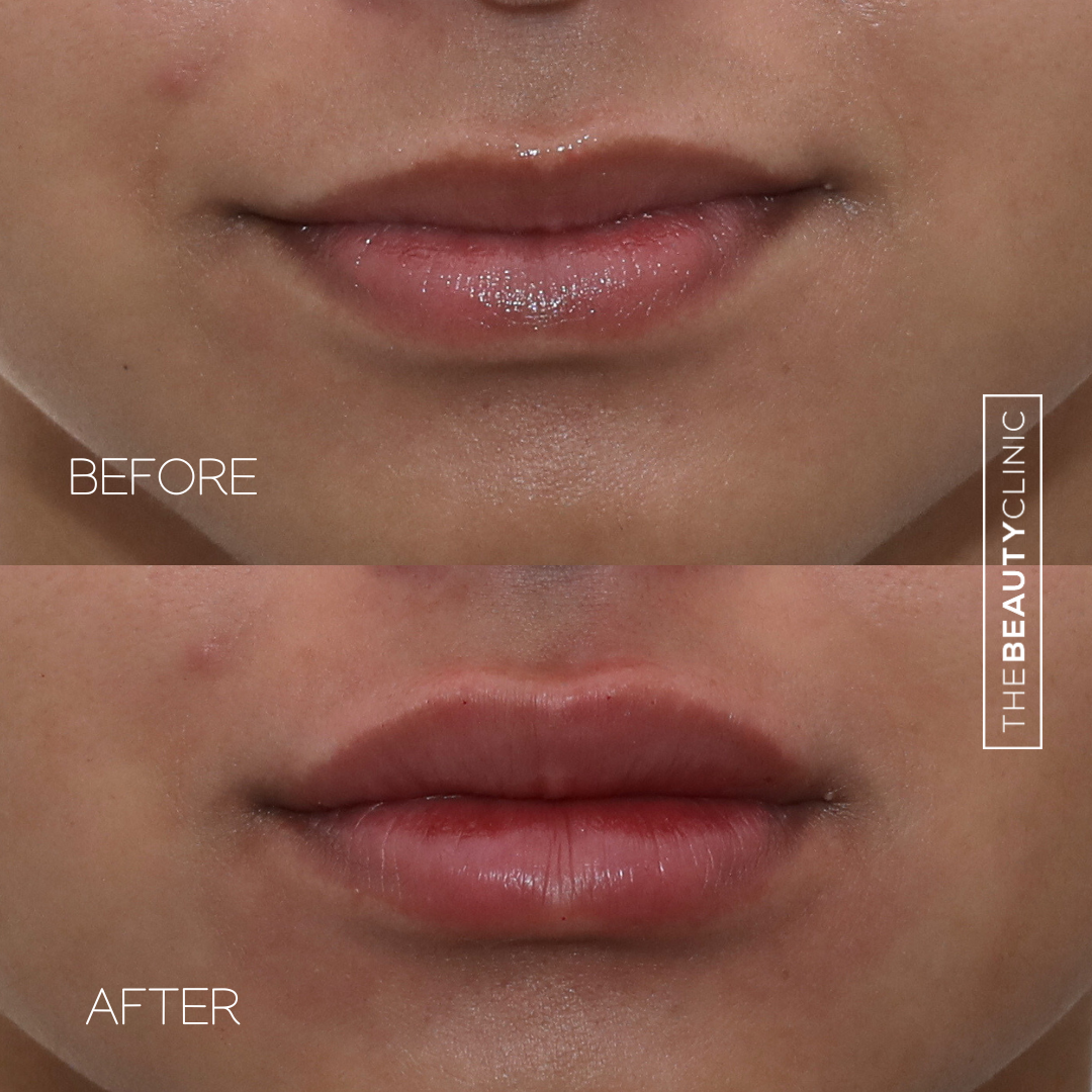 Lip Filler - Before and After - The Beauty Clinic