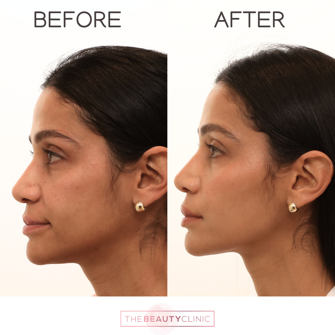 The beauty clinic - Facial Balancing with Filler - Before and after - filler