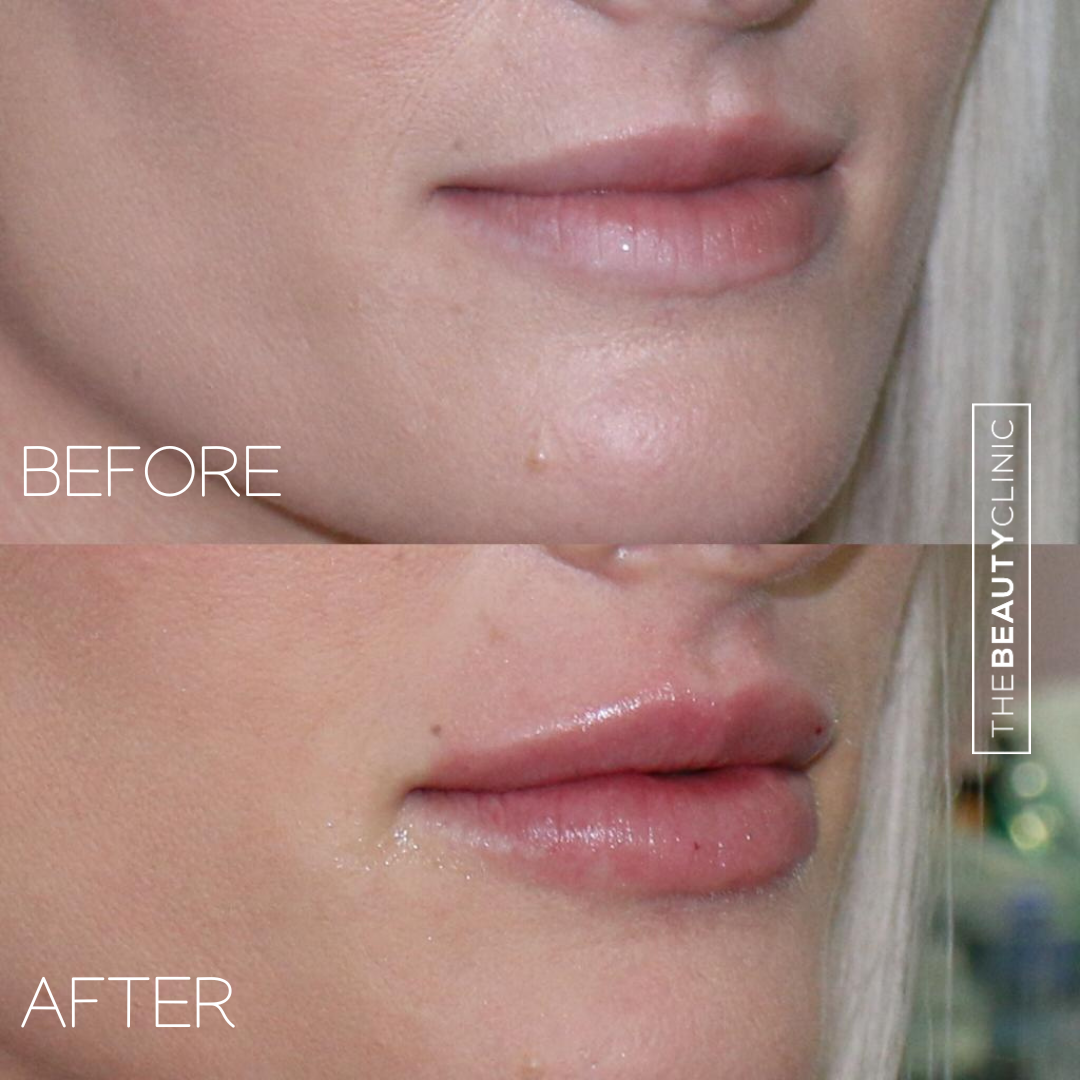 Lip Filler - Before and After - The Beauty Clinic