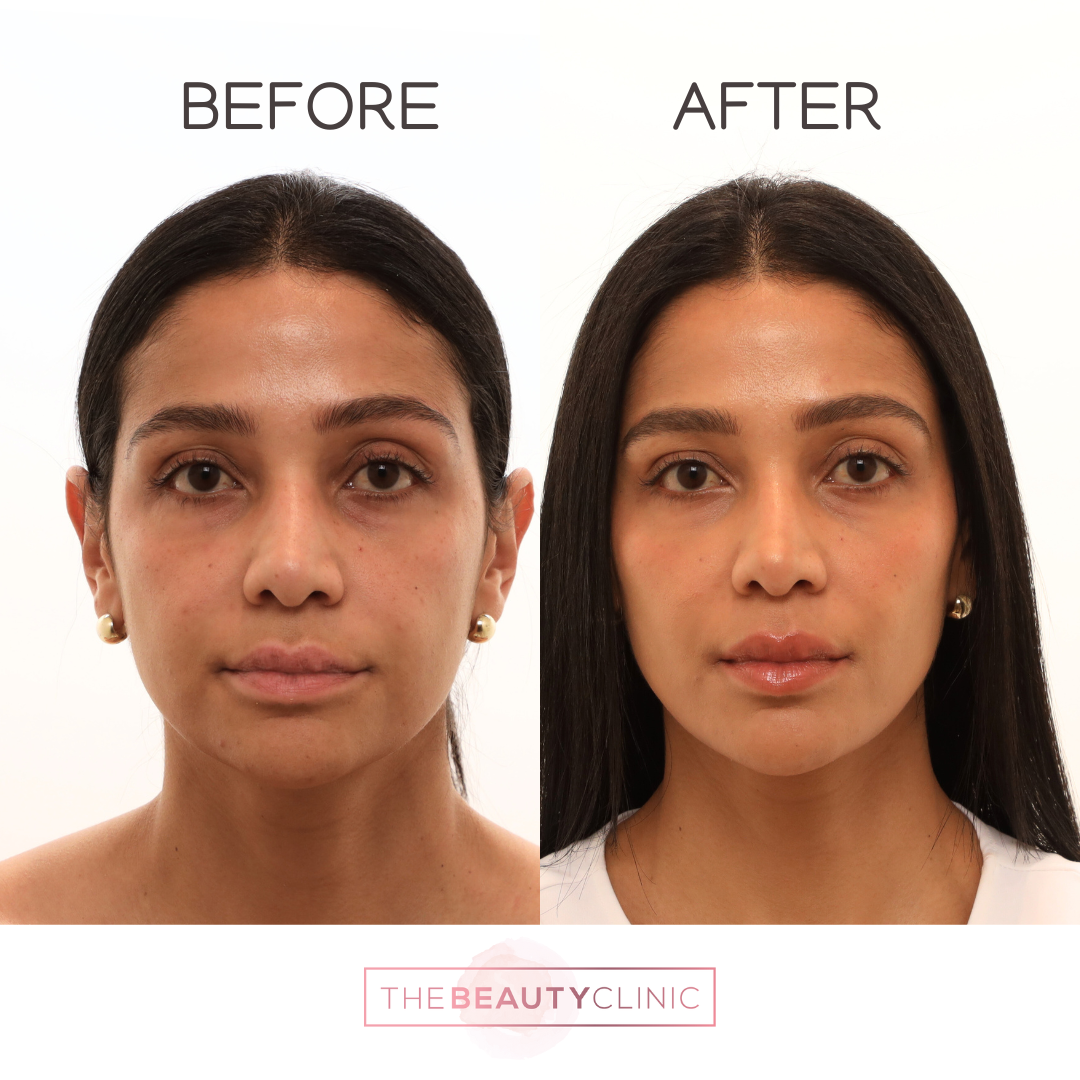 The beauty clinic - Facial Balancing with Filler - Before and after - filler