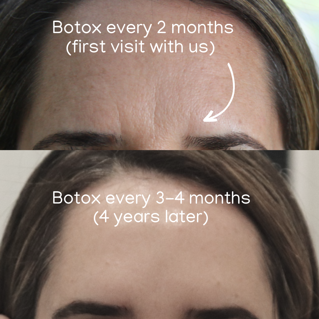 The Beauty Clinic - Toxins - Before and After