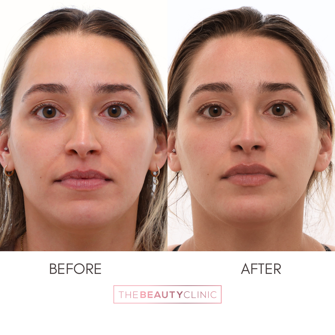 PRF EZGel Biofiller - Before and After - The Beauty Clinic