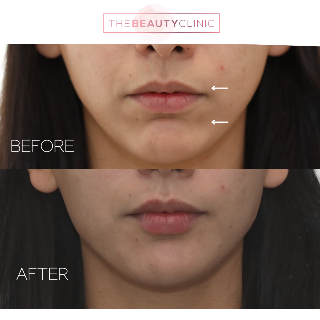 Lip Filler - Before and After - The Beauty Clinic