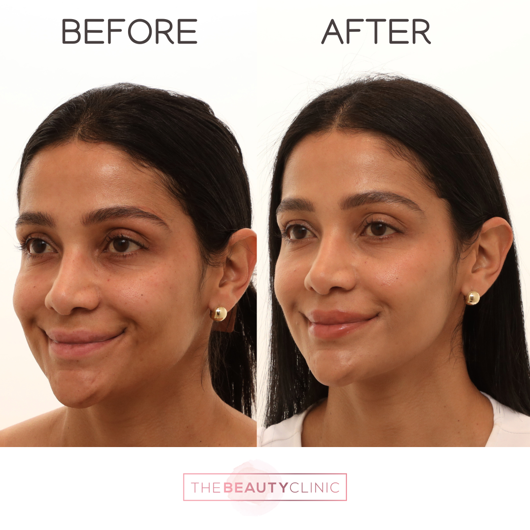 The beauty clinic - Facial Balancing with Filler - Before and after - filler