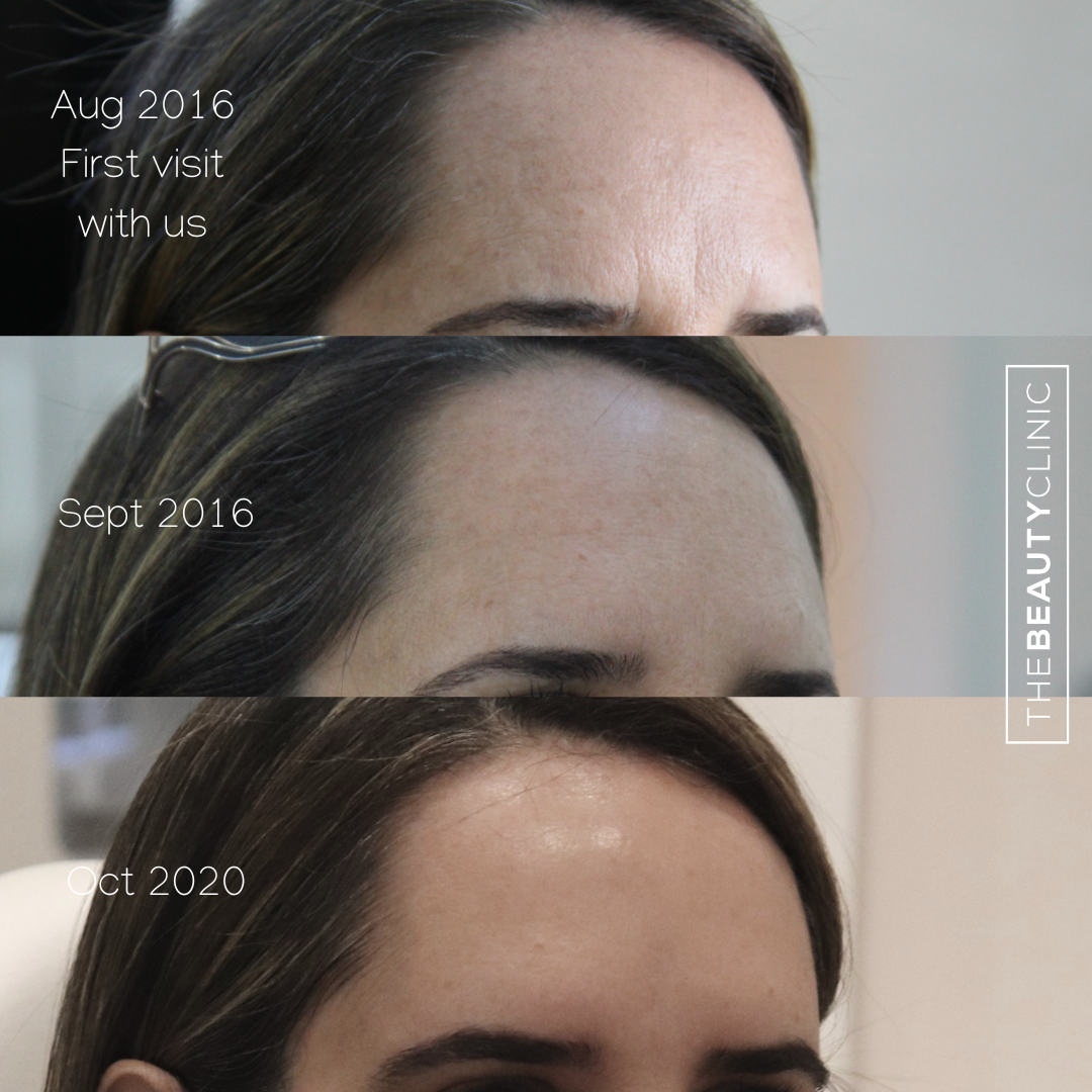 The Beauty Clinic - Toxins - Before and After