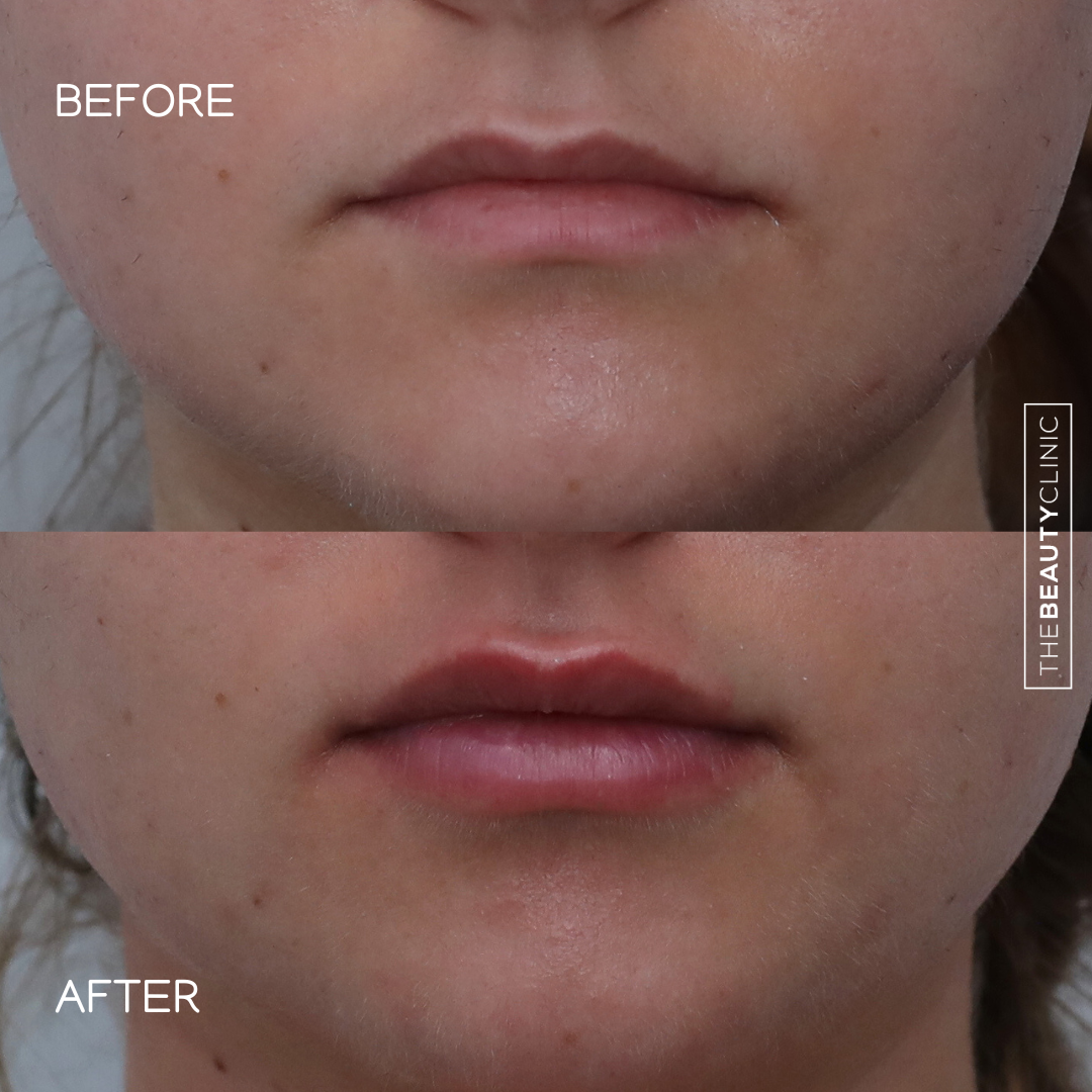 Lip Filler - Before and After - The Beauty Clinic