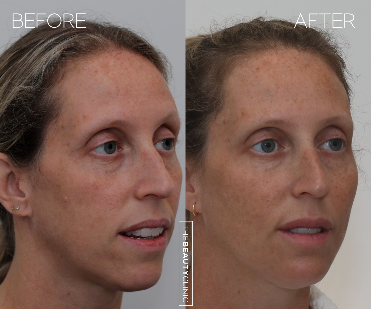 The beauty clinic - Facial Balancing with Filler - Before and after - filler