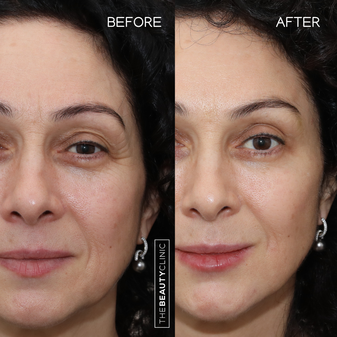 The Beauty Clinic - Toxins - Before and After