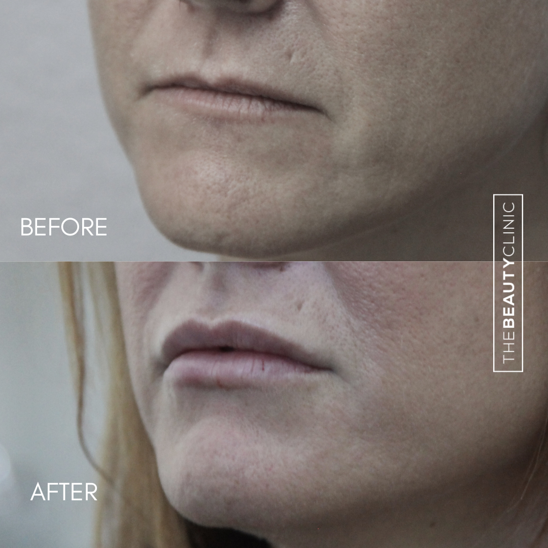 Lip Filler - Before and After - The Beauty Clinic