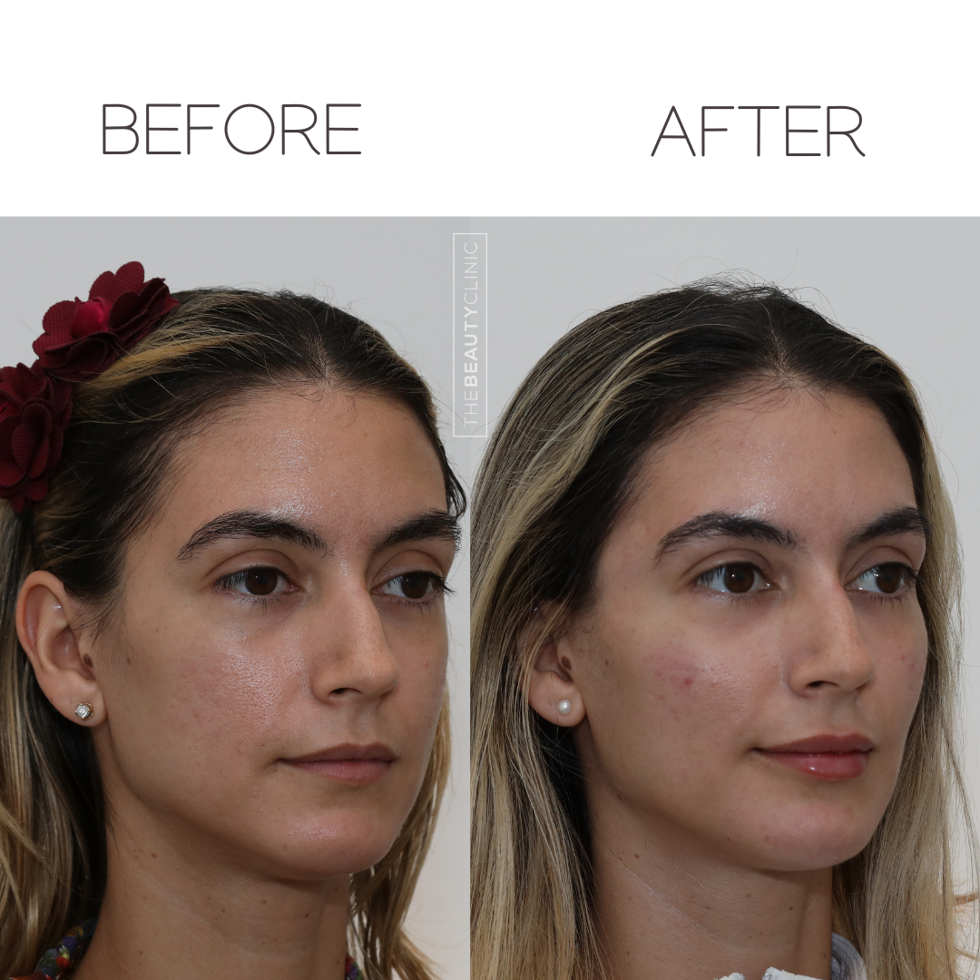 The beauty clinic - Facial Balancing with Filler - Before and after - filler