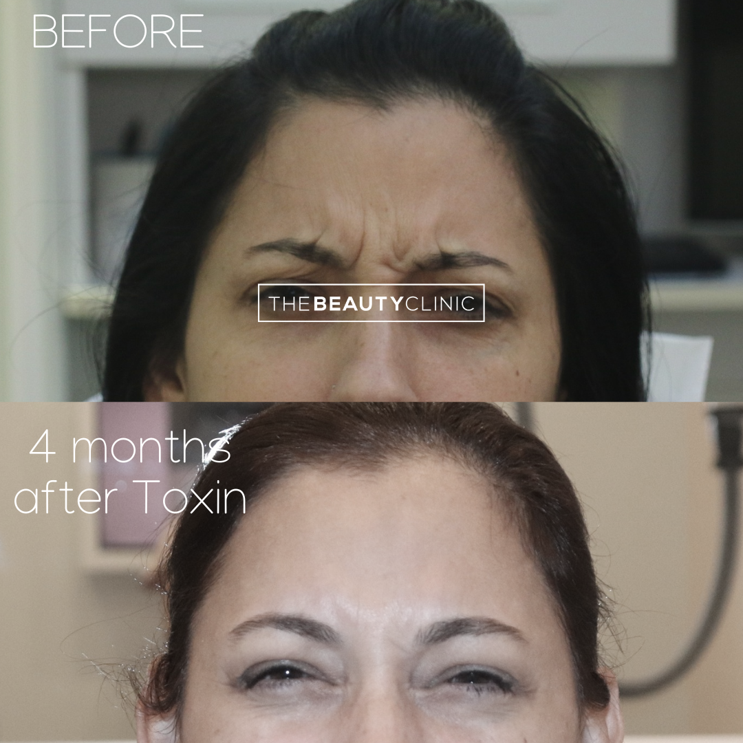 The Beauty Clinic - Toxins - Before and After