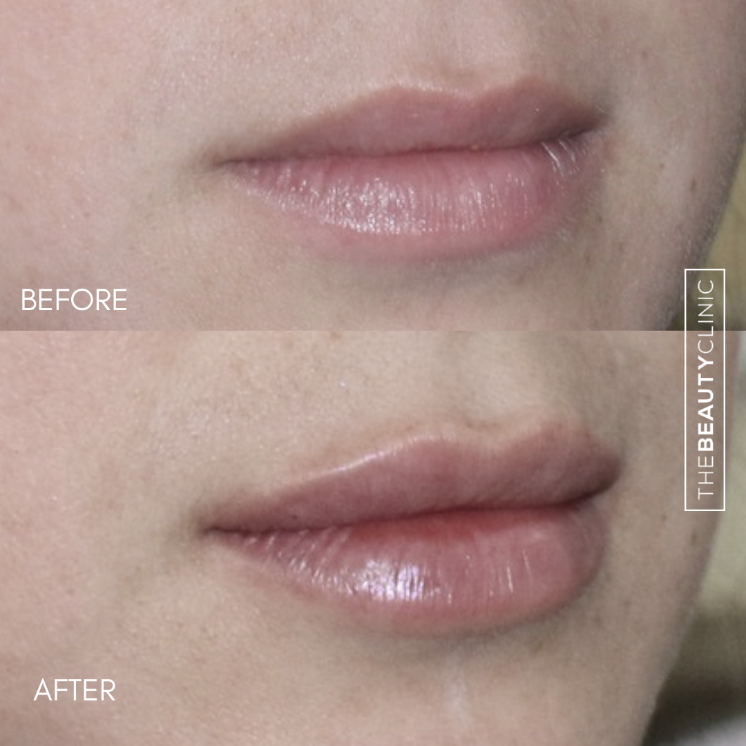 Lip Filler - Before and After - The Beauty Clinic