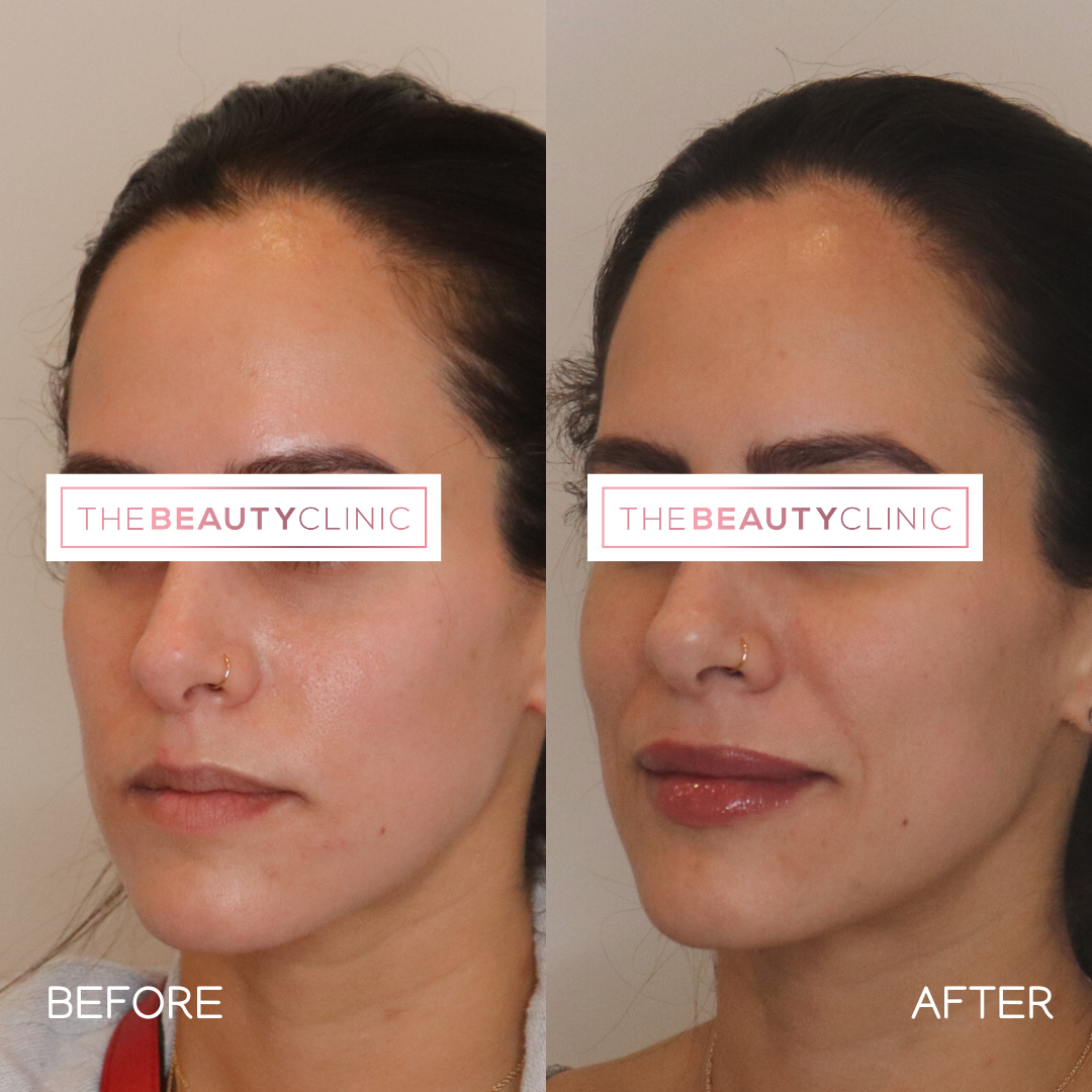 Lip Filler - Before and After - The Beauty Clinic