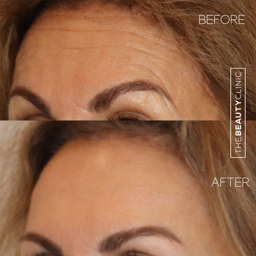 The Beauty Clinic - Toxins - Before and After