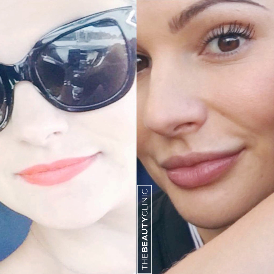 Lip Filler - Before and After - The Beauty Clinic