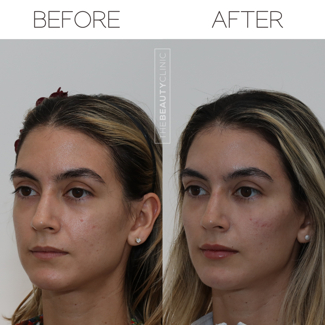 The beauty clinic - Facial Balancing with Filler - Before and after - filler